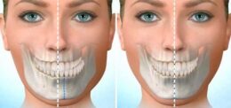 Çene Cerrahisi İle Tedavi Yöntemleri