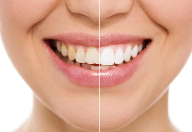 Diş Beyazlatma, Diş beyazlatmak, Kalıcı diş beyazlatma, Lazer ile kalıcı diş beyazlatma
