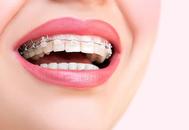 Çene bozuklukları, Çene problemleri, Ortodonti, Ortodonti uygulamaları, Ortodonti tedavisi, Ortodonti tedavi süreci, Diş teli