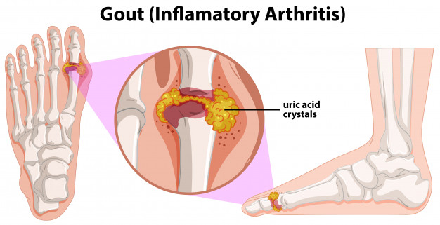 Gout hastalığı ve c vitamini