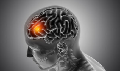 Beyin sisi nedir belirtileri tedavisi